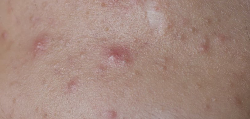 Aknebenägen Hud