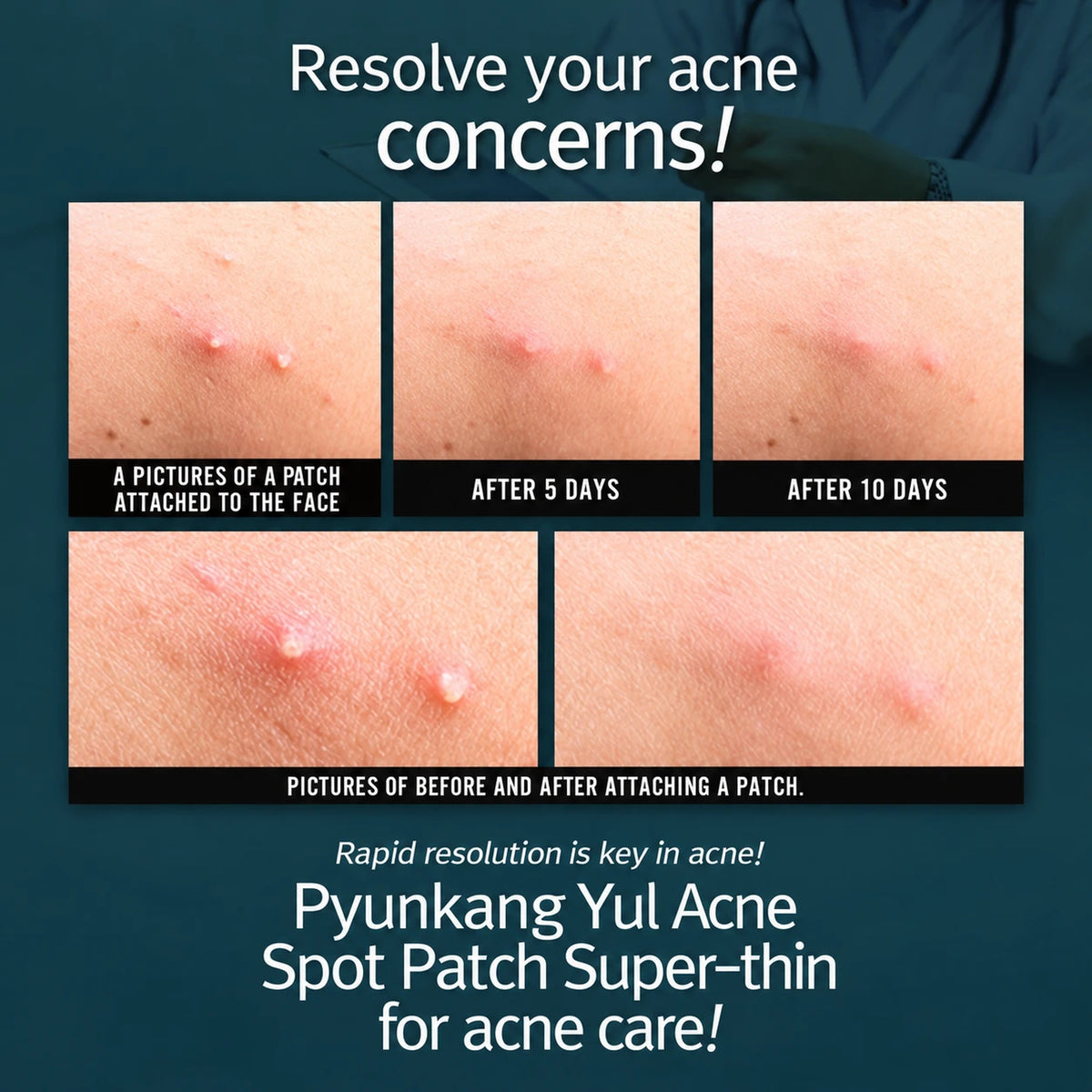 Pyunkang Yul Acne Spot Patch Super Thin 15-Patches